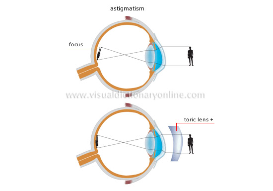 vision defects [3]