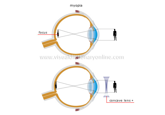 vision defects [1]